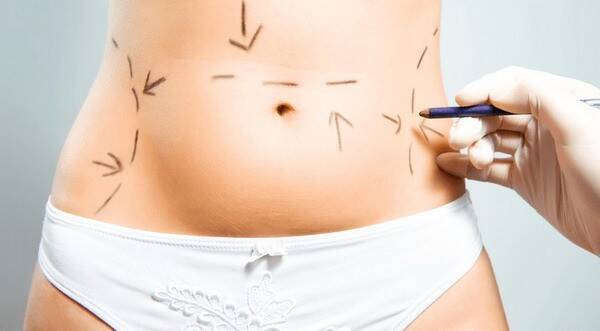 Abdominoplastía