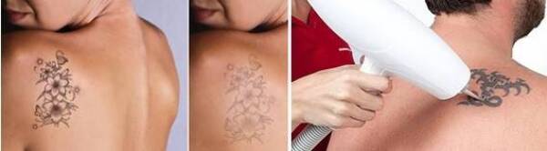 BORRADO DE TATUAJES