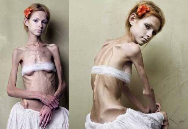 bulimia-ner