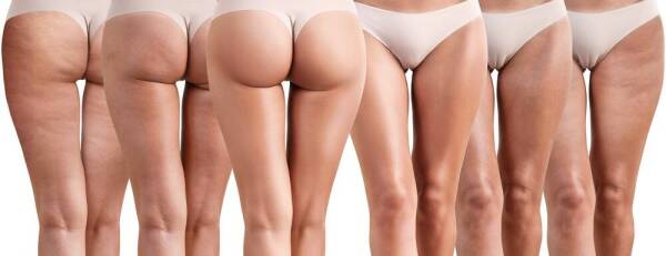celulitis 1